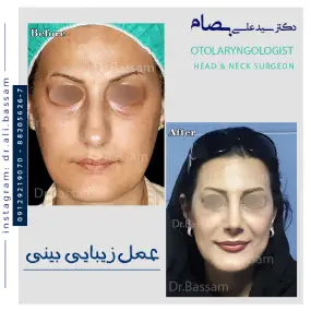 هزینه عمل بینی در سال 1403