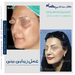 هزینه عمل بینی زنانه