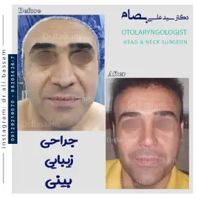 هزینه عمل بینی مردانه