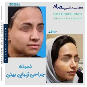 هزینه عمل بینی پهن