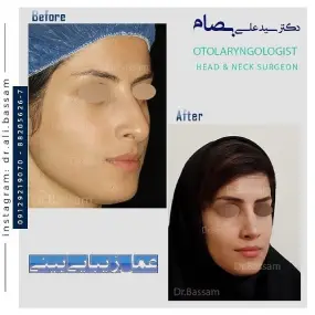 هزینه عمل بینی