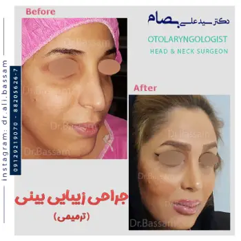 هزینه عمل بینی طبیعی