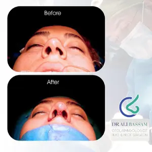 اصلاح پره های بینی