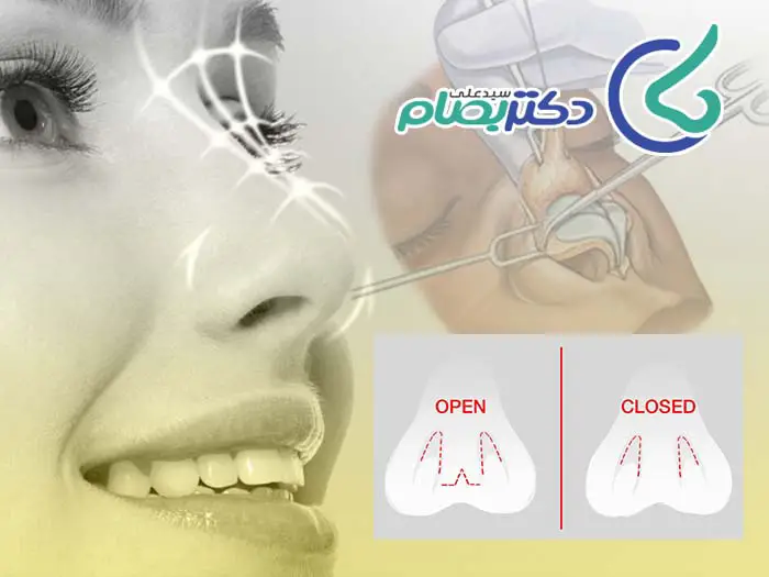 جراحی بینی بسته