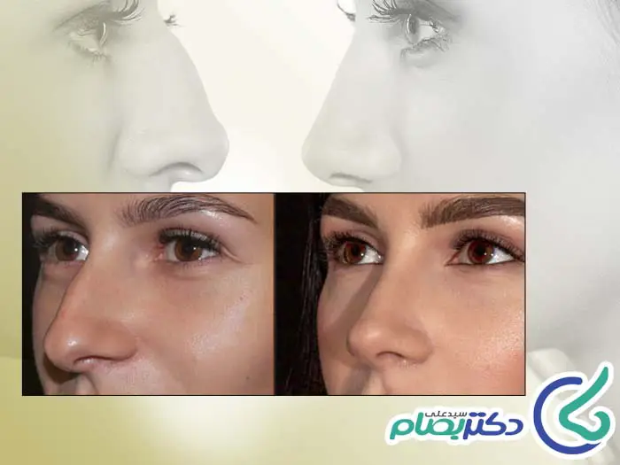 جراحی بینی عقابی