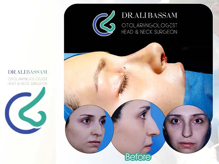 عمل بینی بسته