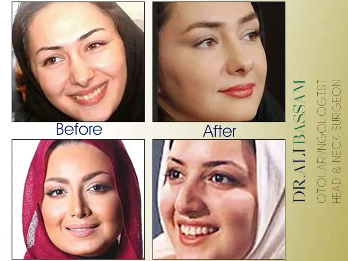 عمل بینی سلبریتی ها