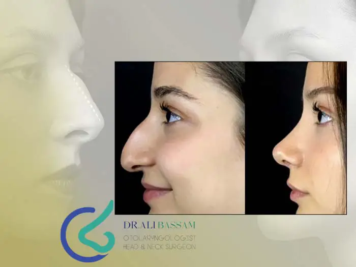 عمل بینی عقابی