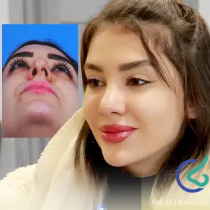 عمل پره بینی