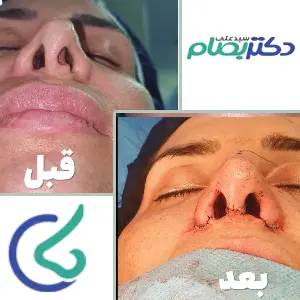 نتیجه عمل پره های بینی