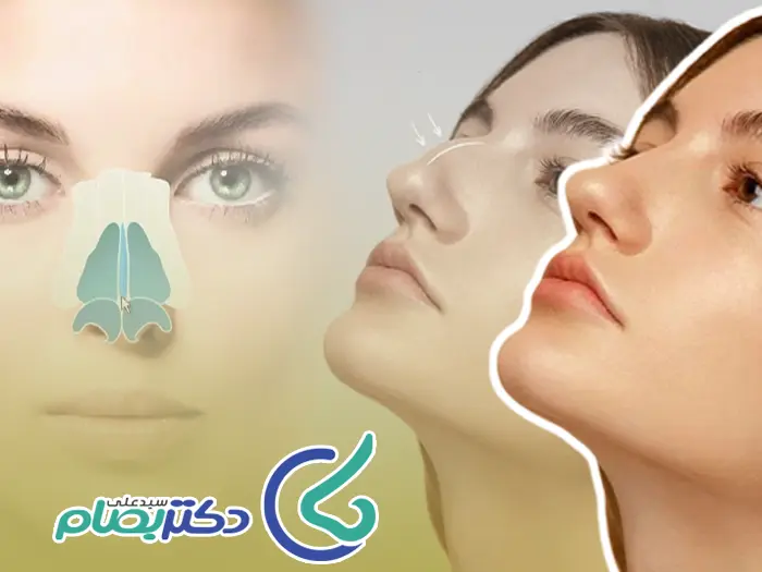 تغییرات صدا بعد رینوپلاستی