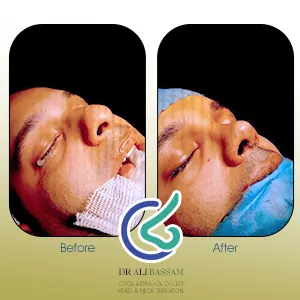 تصویر قبل و بعد عمل بینی گوشتی