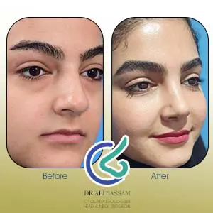 عکس بینی گوشتی دخترانه