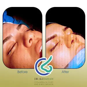 عکس عمل بینی پهن