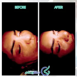 عکس عمل بینی گوشتی