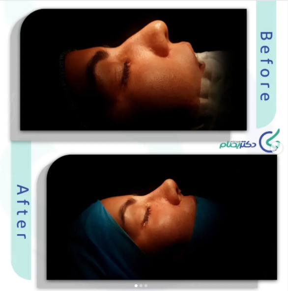 عکس عمل بینی