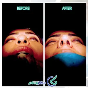 عکس قبل و بعد عمل بینی گوشتی