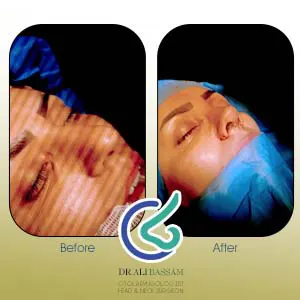 عکس نتیجه بلافاصله بعد عمل