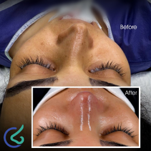 قبل و بعد بینی طبیعی