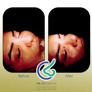 گالری تصاویر عمل بینی گوشتی