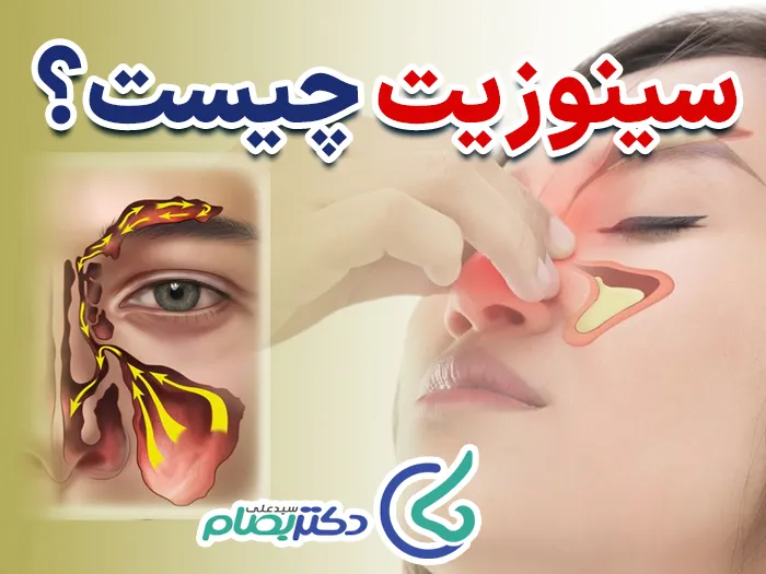 داروی سینوزیت