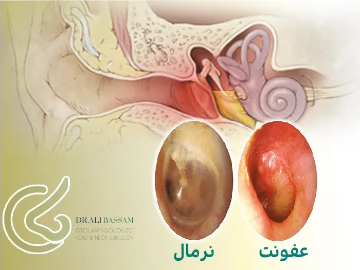 درمان عفونت گوش