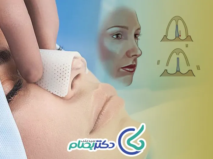 فرورفتگی بینی بعد عمل