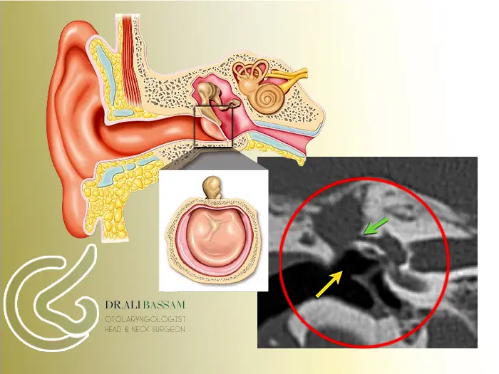 پارگی پرده گوش