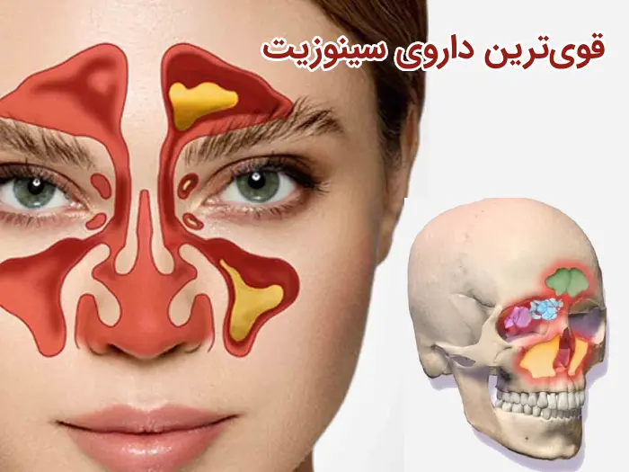 درمان سینوزیت