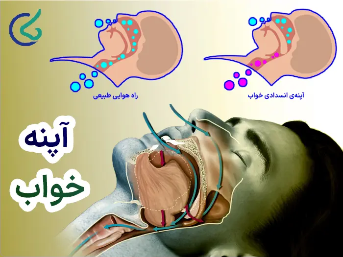 آپنه خواب