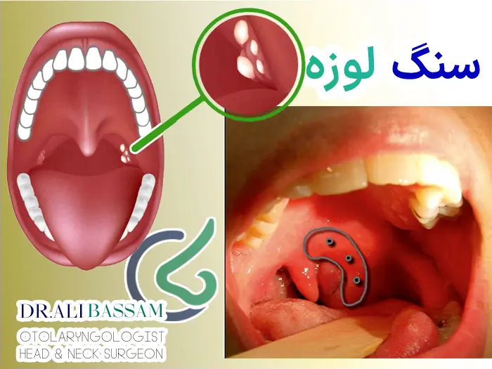 سنگ لوزه