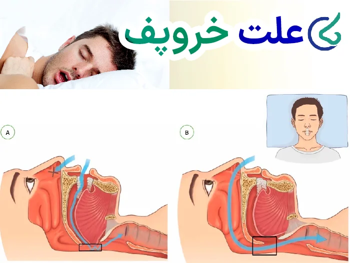 دلیل خروپف