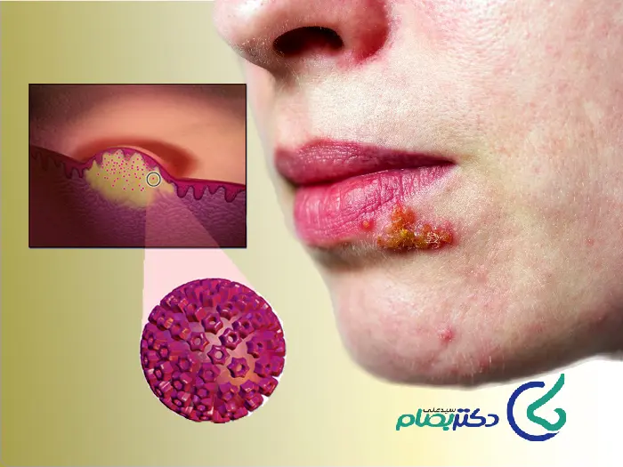 کنترل تبخال قبل عمل