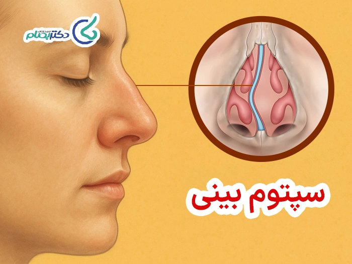 سپتوم بینی