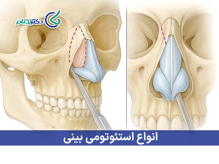 انواع استئوتومی بینی