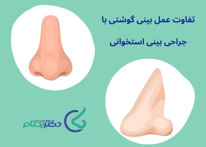 عمل بینی استخوانی با گوشتی