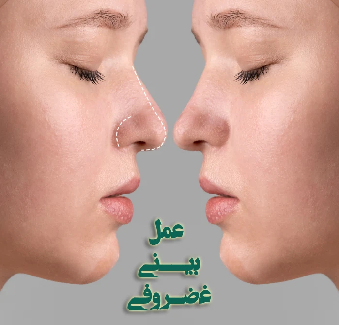 جراحی بینی غضروفی