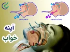 آپنه خواب