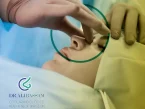 ورم بینی بعد از عمل